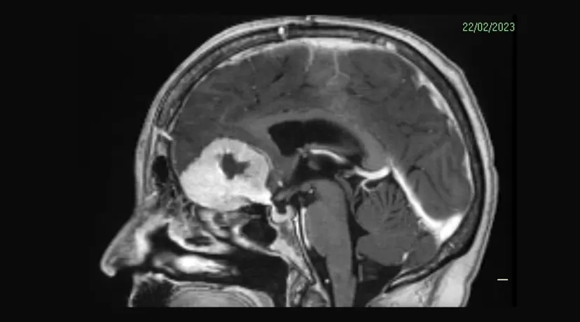 Hospital em Boston é Investigado Após Seis Funcionários Serem Diagnosticados com Tumores Cerebrais